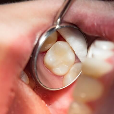 Mirror showing dental sealants on teeth