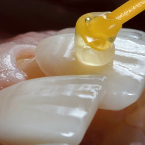 Dental adhesive being applied to a veneer