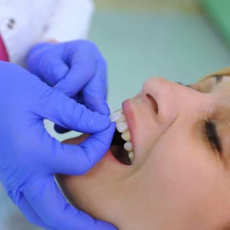 Dentist placing veneer over a patient's tooth