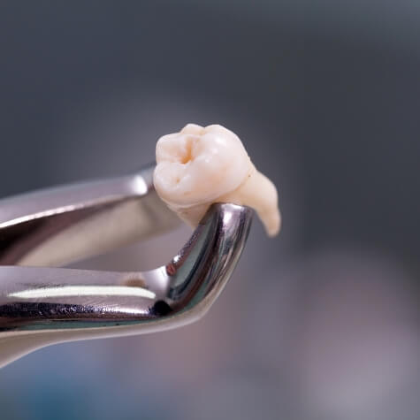 Tooth held in forceps after tooth extraction in Fulshear