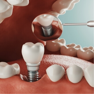 Illustration of dental implant and crown for lower arch