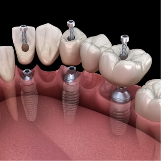 Illustration of dental bridge being attached to dental implants