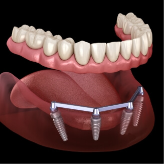 Illustration of full denture being attached to dental implants