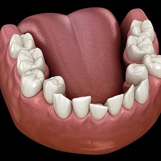 Illustralefton of crowded teeth