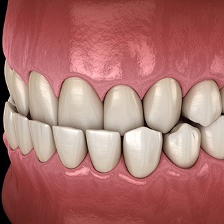 Illustration of underbite