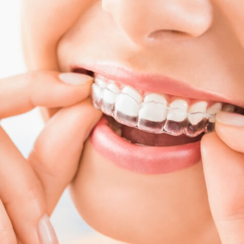 Closeup of smile while putting in Invisalign clear aligner