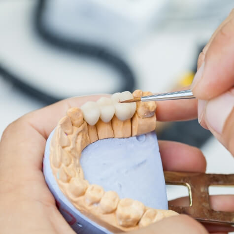 Creating a dental bridge to replace missing teeth in Fulshear