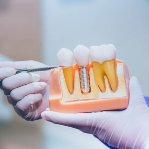 Gloved hands holding a dental implant model