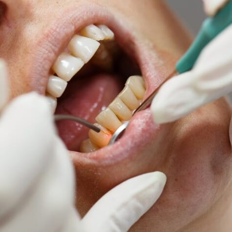 Performing gum disease treatment with a dental laser