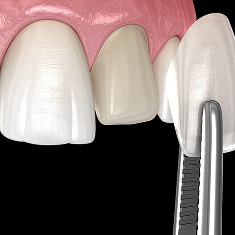 3D render of veneers being placed