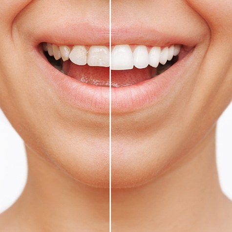 Before and after of veneers